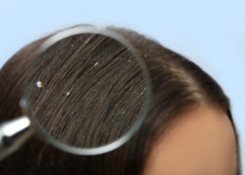 Schuppen goodbye: So bekämpfst du trockene Kopfhaut effektiv und schonend!